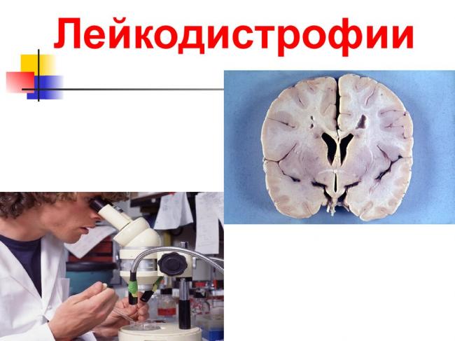 Адренолейкодистрофия - adrenoleukodystrophy - qwe.wiki