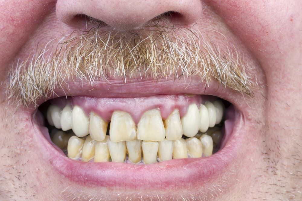 5 способов устранить кровоточивость десен