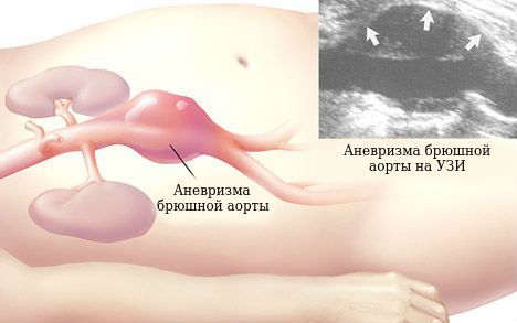 Аневризма аорты брюшной полости: симптомы, причины, лечение, виды аневризмы, операция