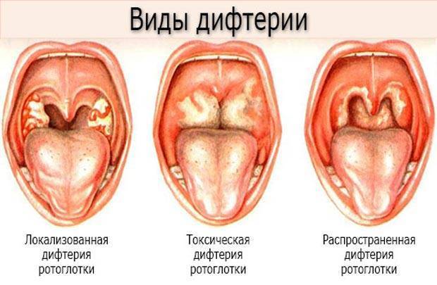 Прививка от дифтерии детям: сроки и побочные эффекты