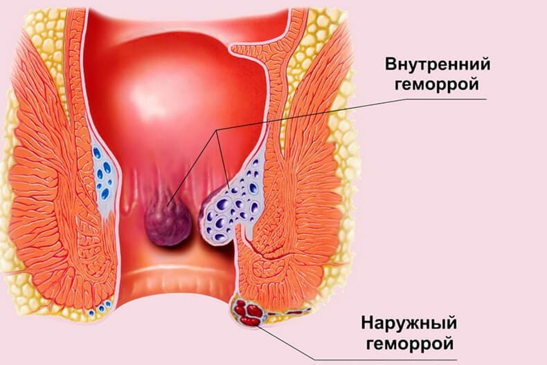 Боль в заднем проходе - причины, характер, лечение. причины и возможные заболевания вызывающие зуд в заднем проходе после опорожнения кишечника — диагностика, лечение и профилактика