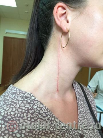Шишка на лице под кожей