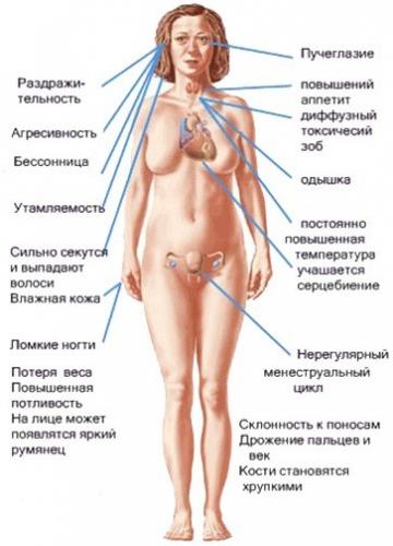 Эндемический зоб щитовидной железы: причины, симптомы, лечение, профилактика, диагностика