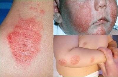 Почему чешутся и зудят коленки: причины и методы лечения