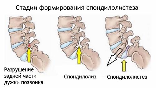 Смещение позвоночника симптомы и последствия
