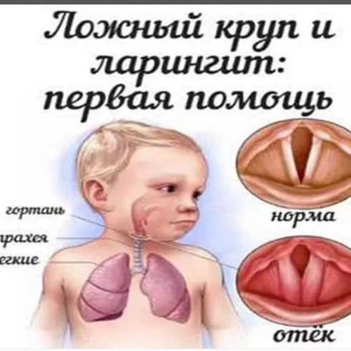 Ложный круп у детей – как не пропустить опасные симптомы и оказать помощь малышу?