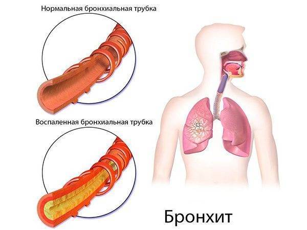 Слизь в носоглотке у взрослого лечение