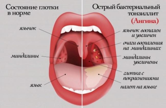Больно глотать с правой стороны и нет температуры – колющая боль