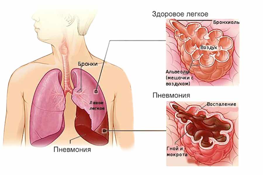 Врожденная пневмония патогенез