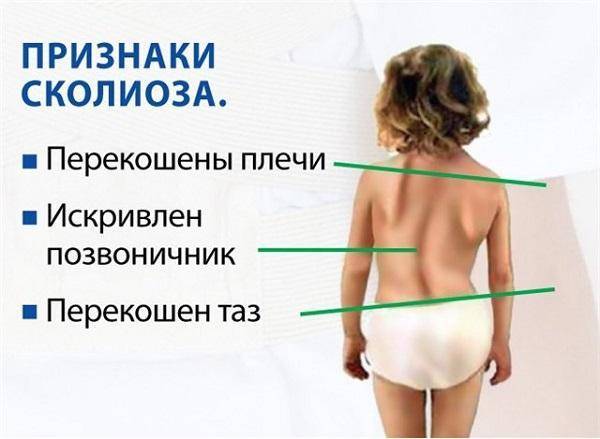 Лфк при сколиозе у детей и подростков