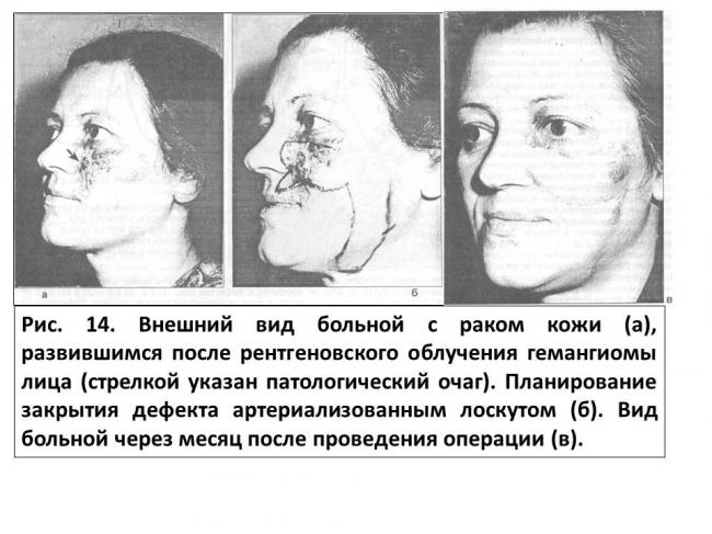 Неврит лицевого нерва (паралич белла)