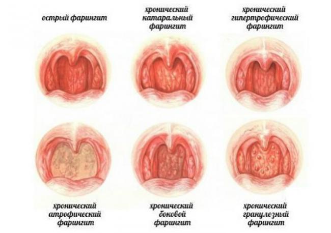 Ларингит у взрослых — симптомы и лечение, что это такое, фото, первые признаки ларингита