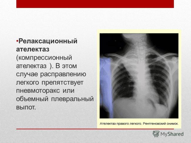 Ателектаз легких у новорожденных