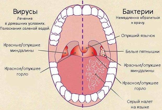 Фарингит – лекарства для лечения и эффективные противовирусные препараты