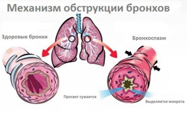 Гормональные уколы при астме