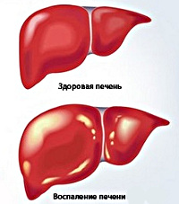 Хронические гепатиты.