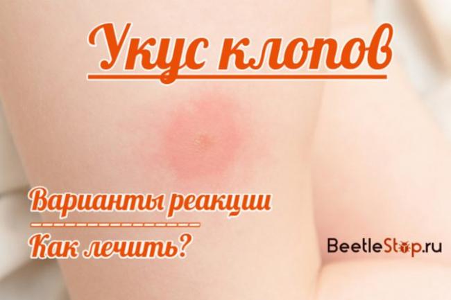 Как избавиться от клопов в квартире раз и навсегда?