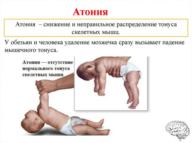 Сенситивная атаксия при рассеянном склерозе