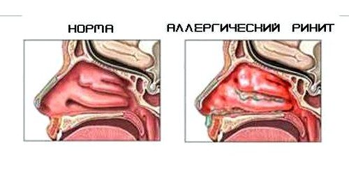 Лечение вазомоторного ринита в домашних условиях