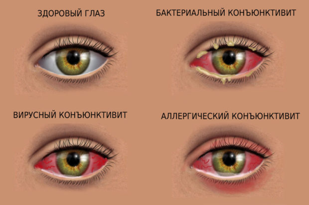 Вирусный конъюнктивит и его терапия: капли, мази, народное лечение