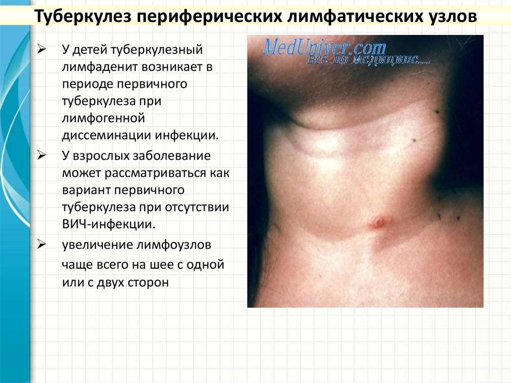 Туберкулез лимфоузлов: заразен или нет, симптомы, лечение
