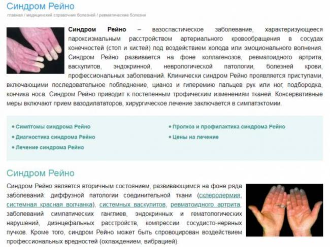 Что это такое – болезнь или синдром рейно