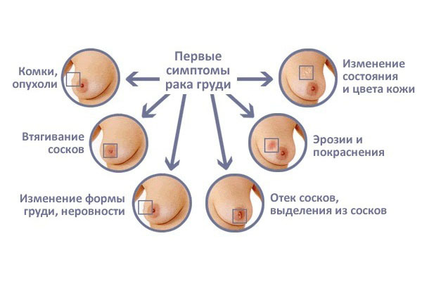 Мастопатия: когда нужна биопсия молочной железы. что такое фиброзно-кистозная мастопатия