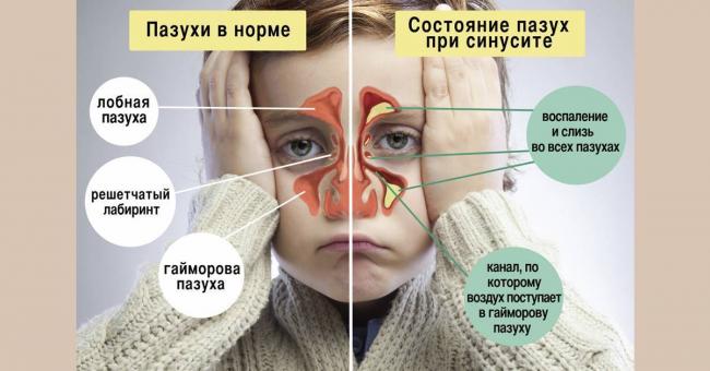 Антибиотики при гайморите, лечение взрослых лекарствами