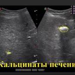 Кальциноз печени: что это такое, симптомы, причины, лечение