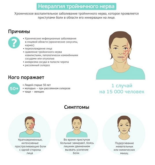 Лечение тройничного нерва