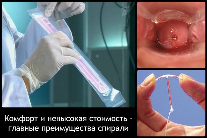 Вмс «мирена»