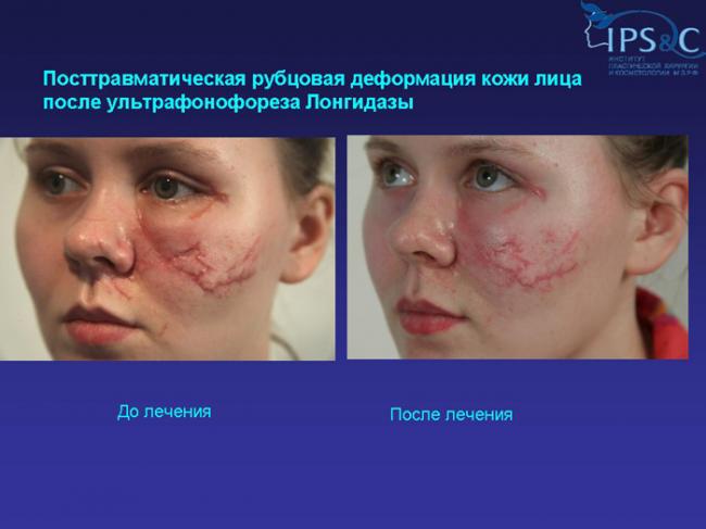 Рубцы и шрамы после операции – помогут ли мази и каковы методы их удаления?