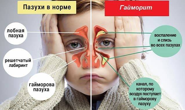 Хронический гайморит — симптомы, осложнения, как вылечить у взрослых