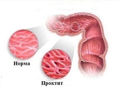 Правила лечебного питания при воспалении прямой кишки