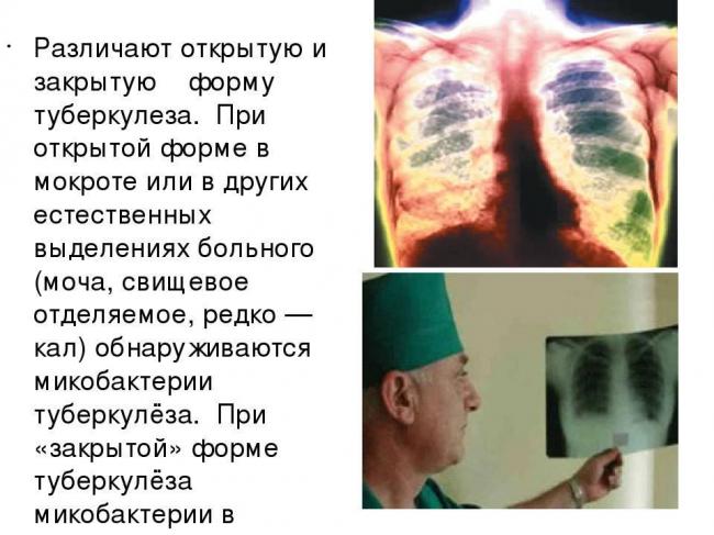 Скрытая форма туберкулеза: лечение и профилактика