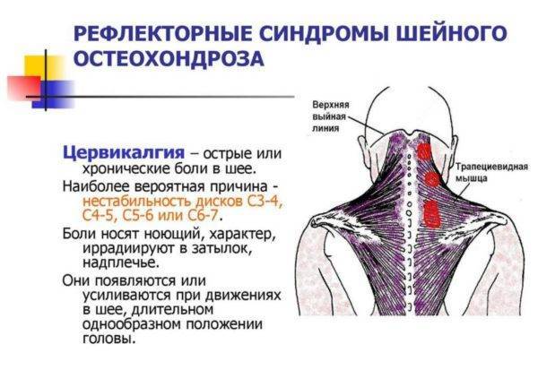 Грыжа диска с5 с6 шейного отдела позвоночника при остеохондрозе
