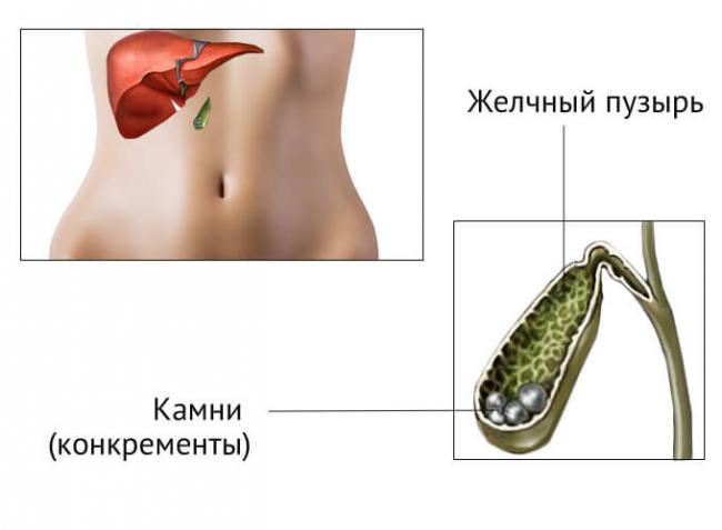 Желчекаменная болезнь - диагностика, лечение и профилактика