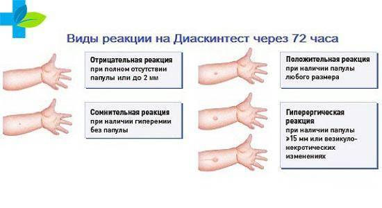 Диаскинтест - что это такое?