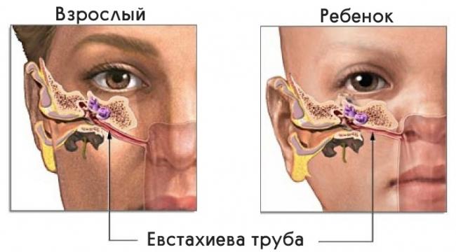 Острый тубоотит: основные симптомы, лечение, осложнения