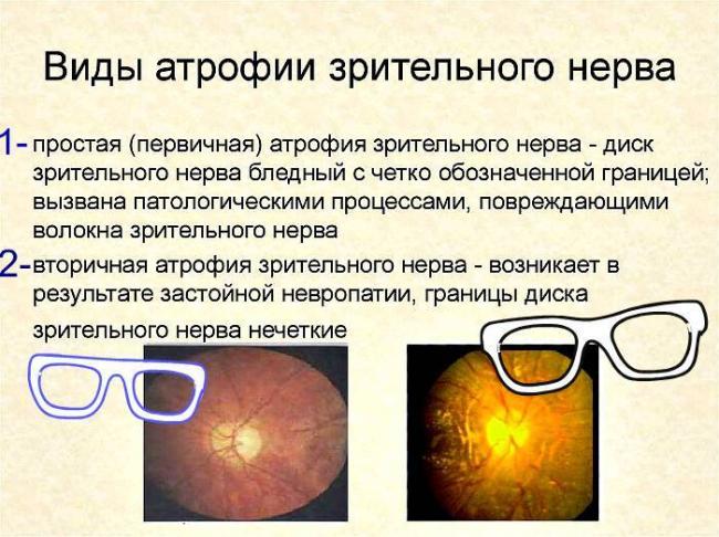 Лечение атрофии зрительного нерва народными средствами