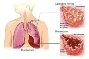 Лечение бронхита. что делать при остром и хроническом течении заболевания и как отличить бронхит от пневмонии