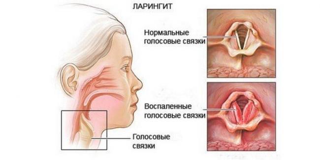 Ларингит