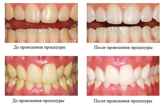 Отбеливание зубов: вред и польза самых действенных методов