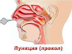 Прокол гайморита: как проходит? как прокалывают? видео