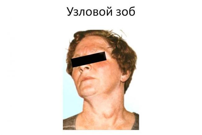 Диффузный зоб щитовидной железы – симптомы и причины развития