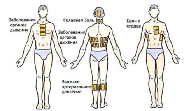 Горчичники при лечении бронхита — показания и особенности применения