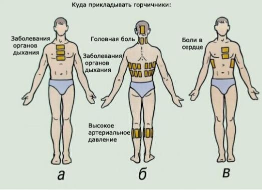 Можно при бронхите ставить банки или горчичники