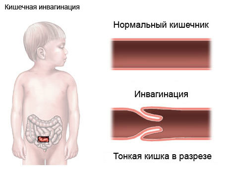 Заворот кишок - причины, симптомы, лечение и операция