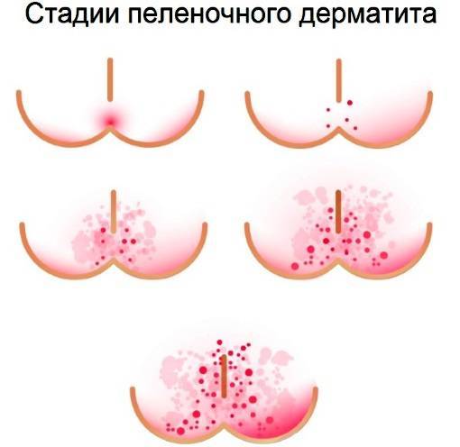 Как проявляется атопический дерматит у детей: симптомы и лечение
