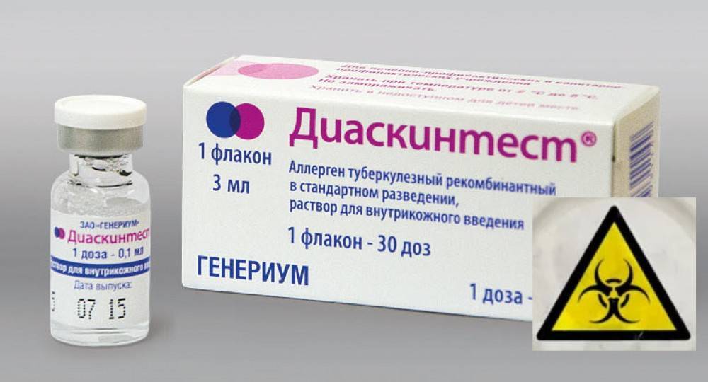 Аллергическая реакция на манту: бывает ли, что предпринять при появлении